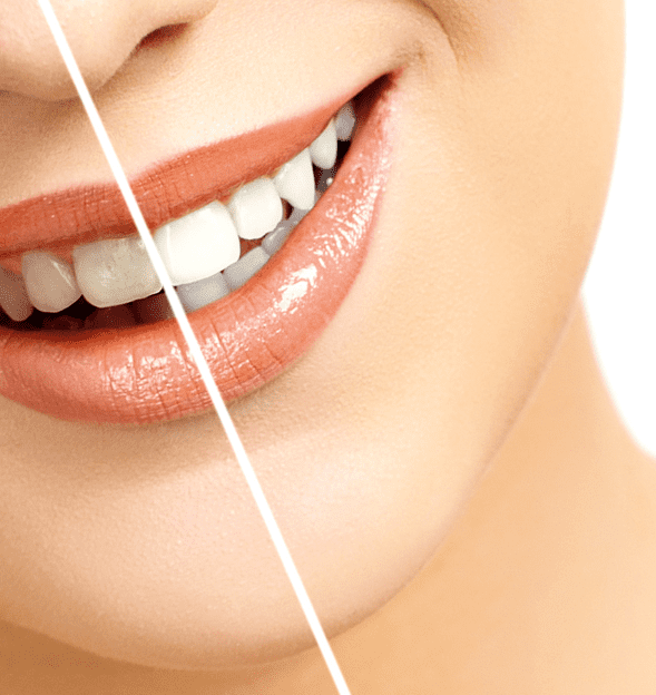 teeth whitening